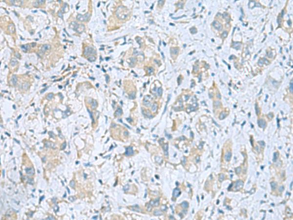 PLN / Phospholamban Antibody - Immunohistochemistry of paraffin-embedded Human liver cancer tissue  using PLN Polyclonal Antibody at dilution of 1:45(×200)