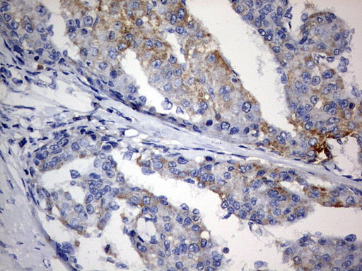 PLOD2 Antibody - IHC of paraffin-embedded Carcinoma of Human liver tissue using anti-PLOD2 mouse monoclonal antibody. (Heat-induced epitope retrieval by 1 mM EDTA in 10mM Tris, pH8.5, 120°C for 3min).