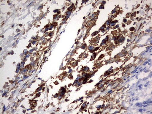 PLOD2 Antibody - IHC of paraffin-embedded Adenocarcinoma of Human ovary tissue using anti-PLOD2 mouse monoclonal antibody. (Heat-induced epitope retrieval by 1 mM EDTA in 10mM Tris, pH8.5, 120°C for 3min).