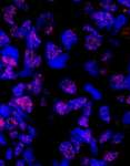 PLRG1 Antibody - Detection of Human PLRG1 by Immunohistochemistry. Sample: FFPE section of human breast carcinoma. Antibody: Affinity purified rabbit anti-PLRG1 used at a dilution of 1:100. Detection: Red-fluorescent goat anti-rabbit IgG highly cross-adsorbed Antibody Hilyte Plus 555 (A120-501E) used at a dilution of 1:100.