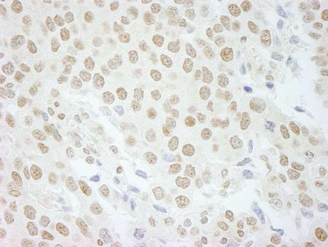 PLRG1 Antibody - Detection of Human PLRG1 by Immunohistochemistry. Sample: FFPE section of human breast carcinoma. Antibody: Affinity purified rabbit anti-PLRG1 used at a dilution of 1:500.