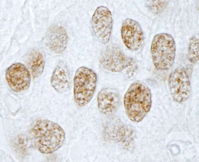 PLRG1 Antibody - Detection of Human PLRG1 by Immunohistochemistry. Sample: FFPE section of human prostate carcinoma. Antibody: Affinity purified rabbit anti-PLRG1 used at a dilution of 1:100.