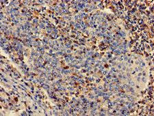 PLS3 / T Plastin Antibody - Immunohistochemistry of paraffin-embedded human cervical cancer at dilution of 1:100