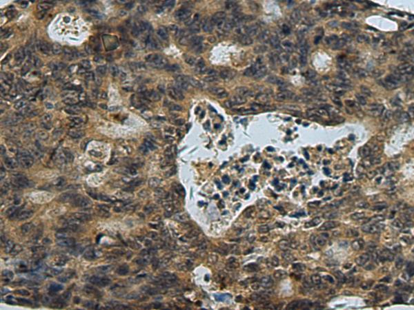 PLTP Antibody - Immunohistochemistry of paraffin-embedded Human colorectal cancer tissue  using PLTP Polyclonal Antibody at dilution of 1:60(×200)