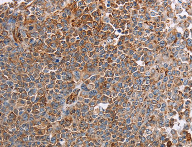 PLXNA2 / Plexin A2 Antibody - Immunohistochemistry of paraffin-embedded Human liver cancer using PLXNA2 Polyclonal Antibody at dilution of 1:40.
