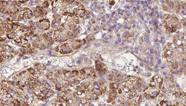 PLXNA2 / Plexin A2 Antibody - 1:100 staining human liver carcinoma tissues by IHC-P. The sample was formaldehyde fixed and a heat mediated antigen retrieval step in citrate buffer was performed. The sample was then blocked and incubated with the antibody for 1.5 hours at 22°C. An HRP conjugated goat anti-rabbit antibody was used as the secondary.