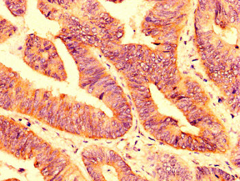 PLXNB1 / Plexin-B1 Antibody - Immunohistochemistry image at a dilution of 1:200 and staining in paraffin-embedded human colon cancer performed on a Leica BondTM system. After dewaxing and hydration, antigen retrieval was mediated by high pressure in a citrate buffer (pH 6.0) . Section was blocked with 10% normal goat serum 30min at RT. Then primary antibody (1% BSA) was incubated at 4 °C overnight. The primary is detected by a biotinylated secondary antibody and visualized using an HRP conjugated SP system.