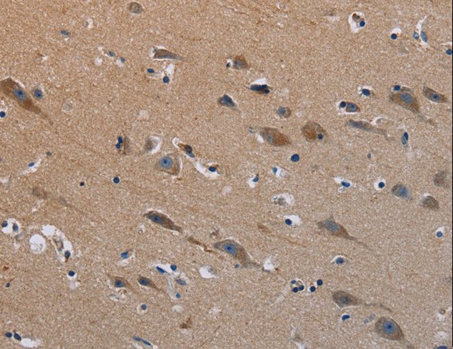 PLXND1 / Plexin D1 Antibody - Immunohistochemistry of paraffin-embedded Human prostate cancer using PLXND1 Polyclonal Antibody at dilution of 1:40.