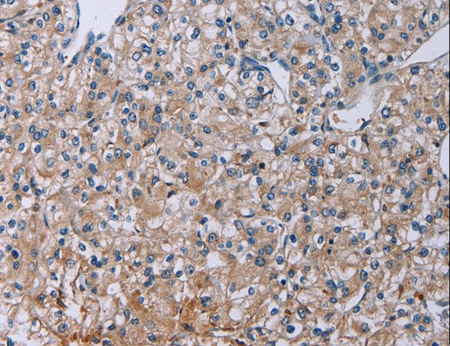 PLXND1 / Plexin D1 Antibody - Immunohistochemistry of paraffin-embedded Human prostate cancer using PLXND1 Polyclonal Antibody at dilution of 1:40.
