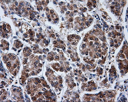 PME-1 / PPME1 Antibody - Immunohistochemical staining of paraffin-embedded Carcinoma of liver tissue using anti-PPME1 mouse monoclonal antibody. (Dilution 1:50).
