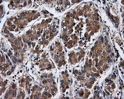 PME-1 / PPME1 Antibody - IHC of paraffin-embedded Carcinoma of liver tissue using anti-PPME1 mouse monoclonal antibody. (Dilution 1:50).