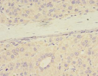 PME-1 / PPME1 Antibody - Immunohistochemistry of paraffin-embedded human liver cancer tissue using antibody at 1:100 dilution.  This image was taken for the unconjugated form of this product. Other forms have not been tested.