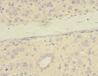 PME-1 / PPME1 Antibody - Immunohistochemistry of paraffin-embedded human liver cancer using PPME1 Antibody at dilution of 1:100