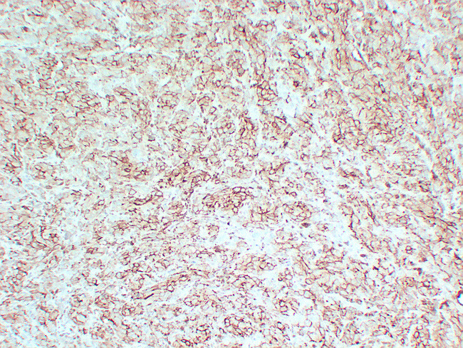 PMEL / SILV / gp100 Antibody - Malignant Melanoma 2