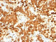 PMEL / SILV / gp100 Antibody - Formalin-fixed, paraffin-embedded human melanoma stained with gp100 antibody (HMB45 + PMEL/783).  This image was taken for the unmodified form of this product. Other forms have not been tested.