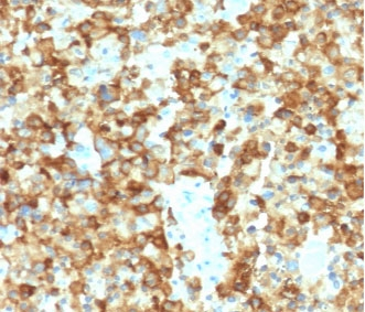 PMEL / SILV / gp100 Antibody - IHC testing of human melanoma with Melanoma gp100 antibody (clone MSSG95-2). Required HIER: boil tissue sections in 10mM citrate buffer, pH 6, for 10-20 min followed by cooling at RT for 20 min.
