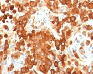 PMEL / SILV / gp100 Antibody - IHC testing of human melanoma with PMEL17 antibody (clone MSSG95).  This image was taken for the unmodified form of this product. Other forms have not been tested.