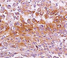 PMEL / SILV / gp100 Antibody - Melanoma gp100 antibody NKI-beteb immunohistochemistry melanoma.  This image was taken for the unmodified form of this product. Other forms have not been tested.