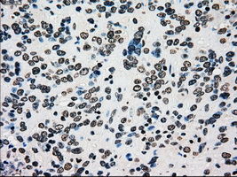 PMEL / SILV / gp100 Antibody - IHC of paraffin-embedded Carcinoma of bladder tissue using anti-SILV mouse monoclonal antibody. (Dilution 1:50).
