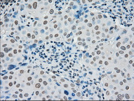 PMEL / SILV / gp100 Antibody - IHC of paraffin-embedded Adenocarcinoma of breast tissue using anti-SILV mouse monoclonal antibody. (Dilution 1:50).