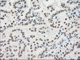PMEL / SILV / gp100 Antibody - IHC of paraffin-embedded Carcinoma of kidney tissue using anti-SILV mouse monoclonal antibody. (Dilution 1:50).