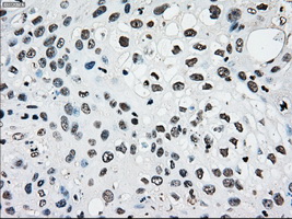 PMEL / SILV / gp100 Antibody - IHC of paraffin-embedded Carcinoma of pancreas tissue using anti-SILV mouse monoclonal antibody. (Dilution 1:50).