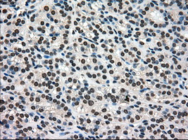 PMEL / SILV / gp100 Antibody - IHC of paraffin-embedded Carcinoma of thyroid tissue using anti-SILV mouse monoclonal antibody. (Dilution 1:50).