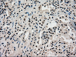 PMEL / SILV / gp100 Antibody - IHC of paraffin-embedded Carcinoma of prostate tissue using anti-SILV mouse monoclonal antibody. (Dilution 1:50).
