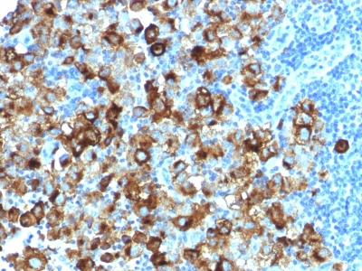 PMEL / SILV / gp100 Antibody - Formalin-paraffin human Melanoma stained with gp100 Rabbit Recombinant Monoclonal Antibody (PMEL/1825R).