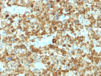 PMEL / SILV / gp100 Antibody - IHC testing of human melanoma with PMEL17 antibody (clone PMEL/2037). Required HIER: boil tissue sections in 10mM citrate buffer, pH 6, for 10-20 min followed by cooling at RT for 20 min.