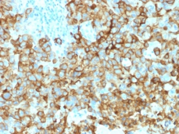 PMEL / SILV / gp100 Antibody - IHC testing of human melanoma with Melanoma gp100 antibody (clone PMEL/2039). Required HIER: boil tissue sections in 10mM citrate buffer, pH 6, for 10-20 min followed by cooling at RT for 20 min.
