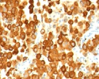 PMEL / SILV / gp100 Antibody - Formalin-fixed, paraffin-embedded human melanoma stained with PMEL17 antibody (PMEL/783).  This image was taken for the unmodified form of this product. Other forms have not been tested.