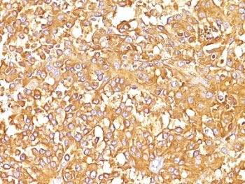 PMEL / SILV / gp100 Antibody - Formalin-fixed, paraffin-embedded human melanoma stained with gp100 antibody (SPM142).  This image was taken for the unmodified form of this product. Other forms have not been tested.