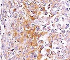 PMEL / SILV / gp100 Antibody - Formalin-fixed, paraffin-embedded human melanoma stained with anti-gp100 antibody (SPM286).  This image was taken for the unmodified form of this product. Other forms have not been tested.