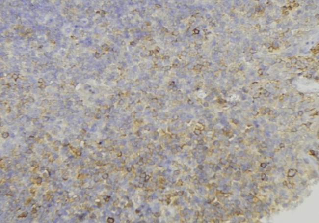 PMEL / SILV / gp100 Antibody - 1:100 staining human lymph node tissue by IHC-P. The sample was formaldehyde fixed and a heat mediated antigen retrieval step in citrate buffer was performed. The sample was then blocked and incubated with the antibody for 1.5 hours at 22°C. An HRP conjugated goat anti-rabbit antibody was used as the secondary.