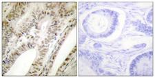 PML Antibody - Immunohistochemistry analysis of paraffin-embedded human tonsil tissue, using PML Antibody. The picture on the right is blocked with the synthesized peptide.