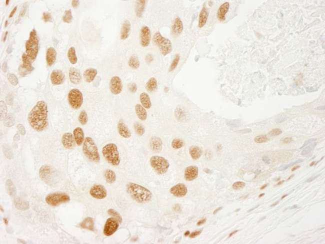 PML Antibody - Detection of Human PML by Immunohistochemistry. Sample: FFPE section of human breast carcinoma. Antibody: Affinity purified rabbit anti-PML used at a dilution of 1:500.