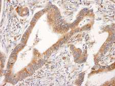 PML Antibody - Detection of Human PML by Immunohistochemistry. Sample: FFPE section of human prostate carcinoma. Antibody: Affinity purified rabbit anti-PML used at a dilution of 1:1000 (0.2 ug/ml). Detection: DAB.