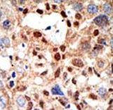 PML Antibody - Formalin-fixed and paraffin-embedded human cancer tissue reacted with the primary antibody, which was peroxidase-conjugated to the secondary antibody, followed by DAB staining. This data demonstrates the use of this antibody for immunohistochemistry; clinical relevance has not been evaluated. BC = breast carcinoma; HC = hepatocarcinoma.