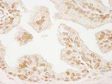 PML Antibody - Detection of Human PML by Immunohistochemistry. Sample: FFPE section of human prostate carcinoma. Antibody: Affinity purified rabbit anti-PML used at a dilution of 1:200 (1 ug/ml). Detection: DAB.