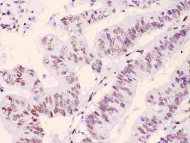 PML Antibody - PML Protein was detected in paraffin-embedded sections of human intetsinal cancer tissues using rabbit anti- PML Protein Antigen Affinity purified polyclonal antibody