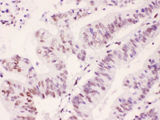 PML Antibody - IHC testing of FFPE human intestinal cancer tissue with PML antibody at 1ug/ml. HIER: steam section in pH6 citrate buffer for 20 min.