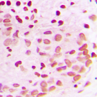 PML Antibody - Immunohistochemical analysis of PML staining in human breast cancer formalin fixed paraffin embedded tissue section. The section was pre-treated using heat mediated antigen retrieval with sodium citrate buffer (pH 6.0). The section was then incubated with the antibody at room temperature and detected using an HRP conjugated compact polymer system. DAB was used as the chromogen. The section was then counterstained with hematoxylin and mounted with DPX.