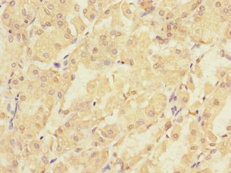 PMM2 Antibody - Immunohistochemistry of paraffin-embedded human gastric cancer at dilution 1:100