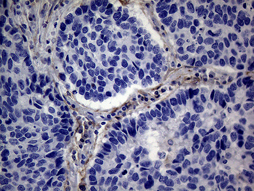 PMP22 Antibody - Immunohistochemical staining of paraffin-embedded Carcinoma of Human lung tissue using anti-PMP22 mouse monoclonal antibody. (Heat-induced epitope retrieval by 1mM EDTA in 10mM Tris buffer. (pH8.5) at 120°C for 3 min. (1:2000)