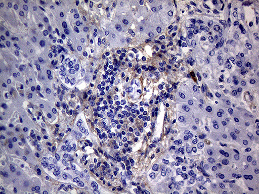 PMP22 Antibody - Immunohistochemical staining of paraffin-embedded Carcinoma of Human liver tissue using anti-PMP22 mouse monoclonal antibody. (Heat-induced epitope retrieval by 1mM EDTA in 10mM Tris buffer. (pH8.5) at 120°C for 3 min. (1:2000)