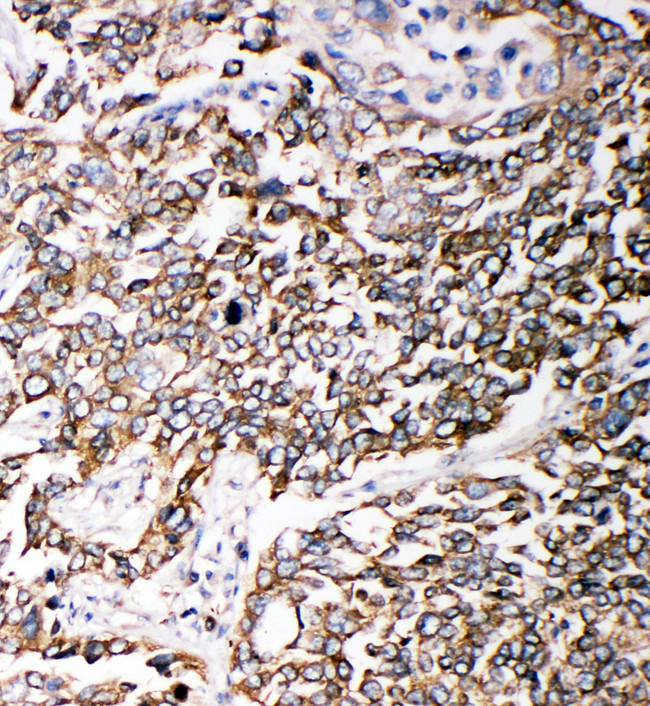 PMP70 Antibody - PMP70 antibody. IHC(P): Human Lung Cancer Tissue.