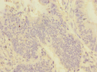 PMPCA Antibody - Immunohistochemistry of paraffin-embedded human colon cancer at dilution 1:100
