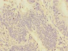 PMPCA Antibody - Immunohistochemistry of paraffin-embedded human colon cancer at dilution 1:100