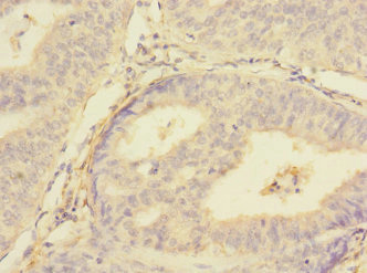 PMPCA Antibody - Immunohistochemistry of paraffin-embedded human endometrial cancer at dilution 1:100
